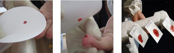 亲子鉴定血痕样本采集方法